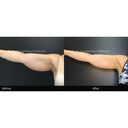 CRISTAL® Fat Freezing: Inner Arms (Prepay 6 x $174.50)