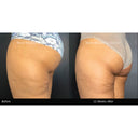 CRISTAL® Fat Freezing: Below Bottom (Prepay 6 x $174.50)