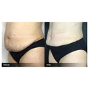CRISTAL® Fat Freezing: Abdomen Debulk (3 Sessions)