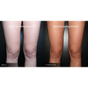 CRISTAL® Fat Freezing: Inner Knees (Prepay 6 x $174.50)