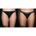 CRISTAL® Fat Freezing: Inner Thighs (Prepay 6 x $174.50)