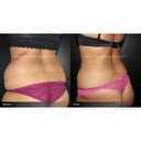 CRISTAL® Fat Freezing: Love Handles (Prepay 6 x $174.50)