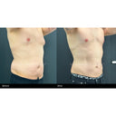 CRISTAL® Fat Freezing: Male Pecs (Prepay 6 x $174.50)