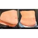 CRISTAL® Fat Freezing: Middle Abs (Prepay 6 x $174.50)