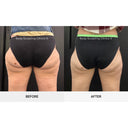 CRISTAL® Fat Freezing: Outer Thighs (Prepay 6 x $174.50)
