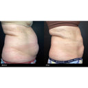 CRISTAL® Fat Freezing: Upper Abs (Prepay 6 x $174.50)
