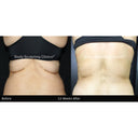 CRISTAL® Fat Freezing: Upper Back (Prepay 6 x $174.50)