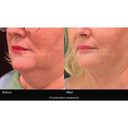 CRISTAL® Fat Freezing: Double Chin (Prepay 3 x $184.50)