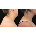 CRISTAL® Fat Freezing: Back Neck (Prepay 3 x $184.50)