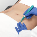 Microneedling: Body Area (A5): Prepay 4 x $124.50