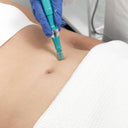 Microneedling: Body Area (A5): Prepay 4 x $124.50