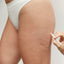 Fat Reduction: Outer Thighs (Prepay 4 x $169)