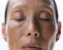 <h3>4 Minimally Invasive Pigmentation Removal Treatments</h3>