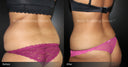 fat freezing before and after upper back